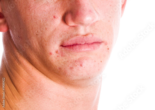 Photo: Acne Face Acne Face