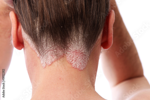Schuppenpflechte-Psoriasis am Haaransatz und auf der kopfhaut