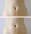 Slimming : before-after Slimming : before-after