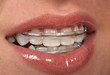 Cosmetic Braces