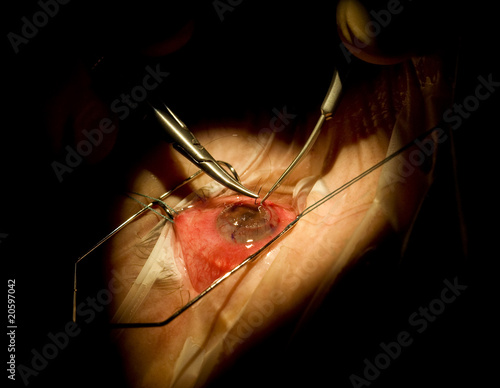Photo: EYE SURGERY EYE SURGERY