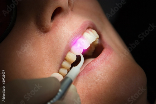 Foto: Dental Laser Zahnbehandlung Zahnfleisch Dental Laser Zahnbehandlung Zahnfleisch