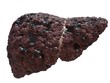 Leberzirrhose