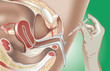 artificial insemination