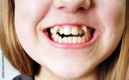Photo: bad teeth bad teeth