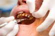 Dental cord placing in gingival sulcus