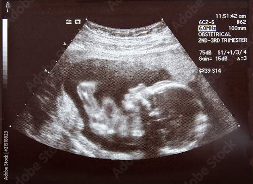 Photo: Ultrasound during second trimester Ultrasound during second trimester