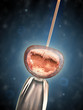 Artificial insemination