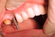Close-up of patient's implantation of teeth applied mouth