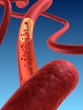 Ader mit  Arteriosklerose