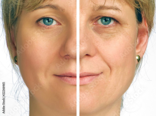 Photo: Correction of wrinkles - half face Correction of wrinkles - half face
