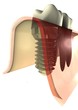 Implantat-Zahnwurzel