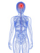 transparenter körper mit Hirntumor