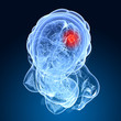 Illustration - Hirntumor