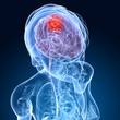 transparenter Kopf mit Gehirntumor