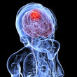 weiblicher Schädel mit Hirntumor