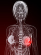 Brustdrüsen mit markiertem Tumor