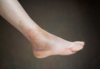 ankle sprain