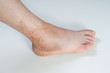 ankle sprain