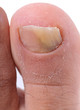 Left foot toe nail suffering from fungus infection.