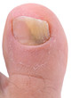 Left foot toe nail suffering from fungus infection.