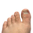Cracked Fungus Toe Nail