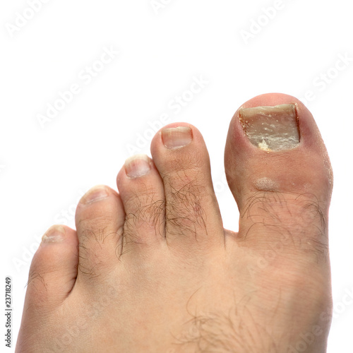 Photo: Cracked Fungus Toe Nail Cracked Fungus Toe Nail