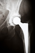 X-ray image of an artificial hip X-ray image of an artificial hip
