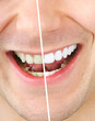 Tooth whitening Tooth whitening