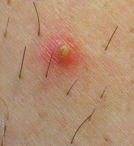 Photo: ingrown hair ingrown hair
