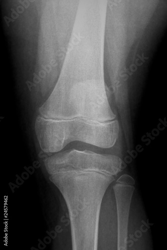 Photo: AP x-ray of injured knee AP x-ray of injured knee