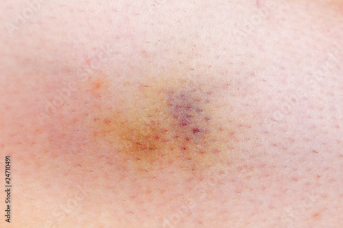 Photo: bruised woman skin bruised woman skin