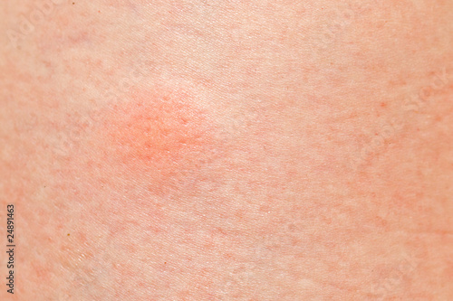 Photo: mosquito pimple on woman skin mosquito pimple on woman skin