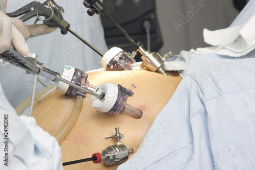 Foto: Gastric bypass surgery Gastric bypass surgery
