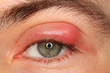 Photo: illness person eye with sty and pus looking into camera illness person eye with sty and pus looking into camera