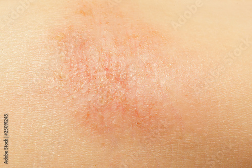 Photo: eczema on child skin eczema on child skin