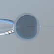 in vitro fertilization