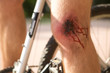 Man with a wound on his knee