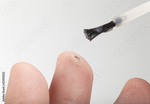 Photo: applying medicine to treat a wart applying medicine to treat a wart