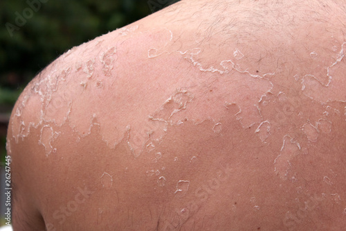 Photo: Peeling Sunburned Back Peeling Sunburned Back