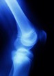 X-ray picture showing knee joints