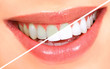 Photo: Teeth whitening Teeth whitening