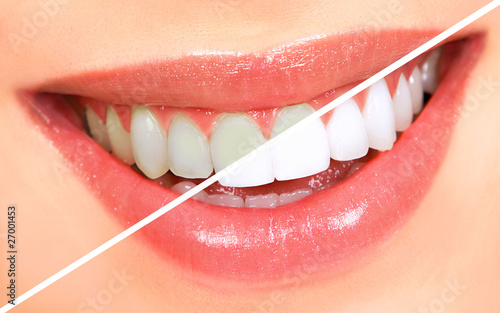 Photo: Teeth whitening Teeth whitening