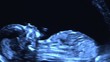 Ultraschallbild Kind