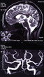 X-ray image of the brain