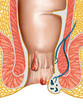 Hemorrhoids