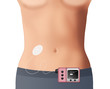 Illustration showing a Diabetic wearing an Insulin Pump