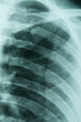 Xray of broken ribs Xray of broken ribs