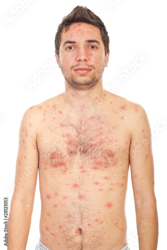 Photo: Man with chickenpox Man with chickenpox