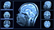 Video: MRI brain scan MRI brain scan